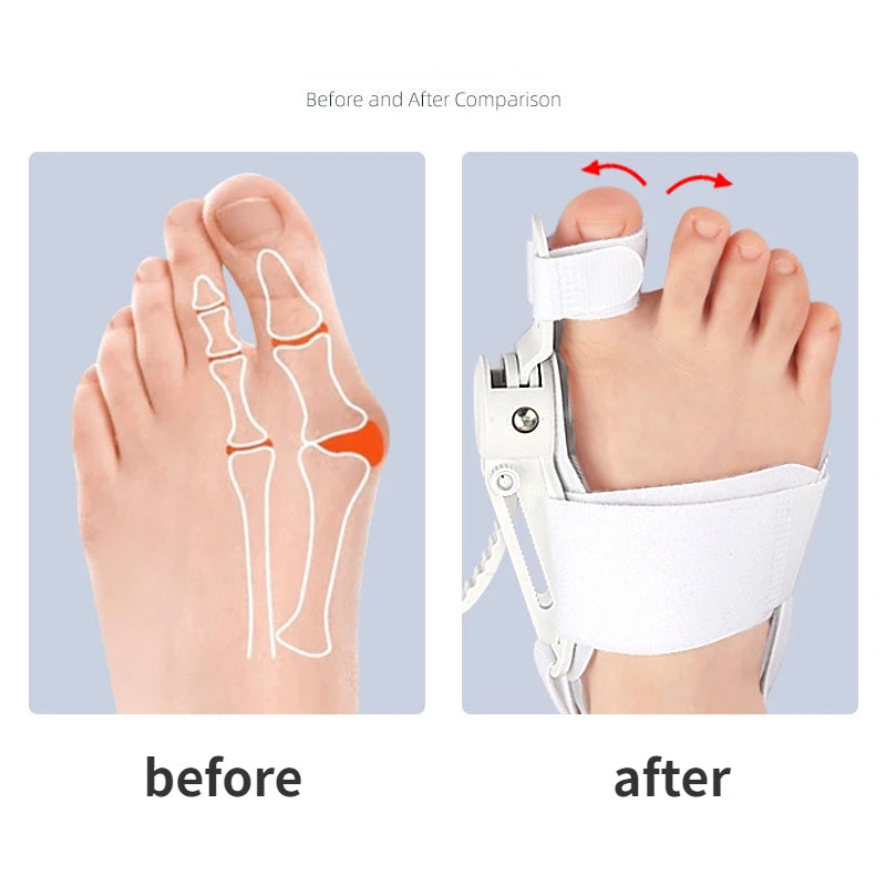 ComfortFit Bunion Corrector – Comfort, Support & Alignment